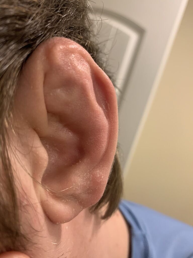 Oreja de Coliflor: Entendiendo Esta Condición Común en Atletas