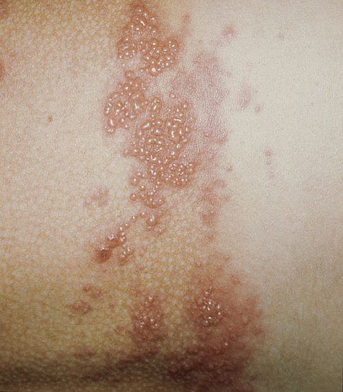Culebrilla (herpes zóster): síntomas, causas, tratamiento y prevención
