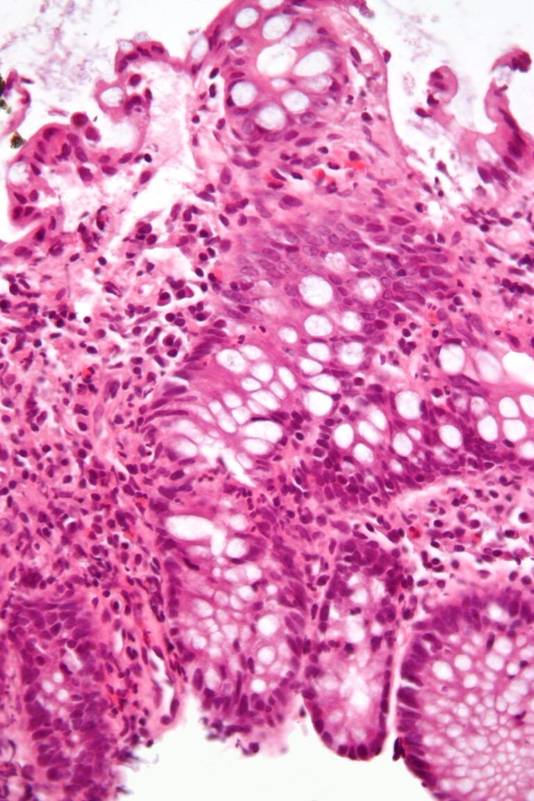 Enfermedad de Crohn: síntomas, causas, tratamiento y alimentación