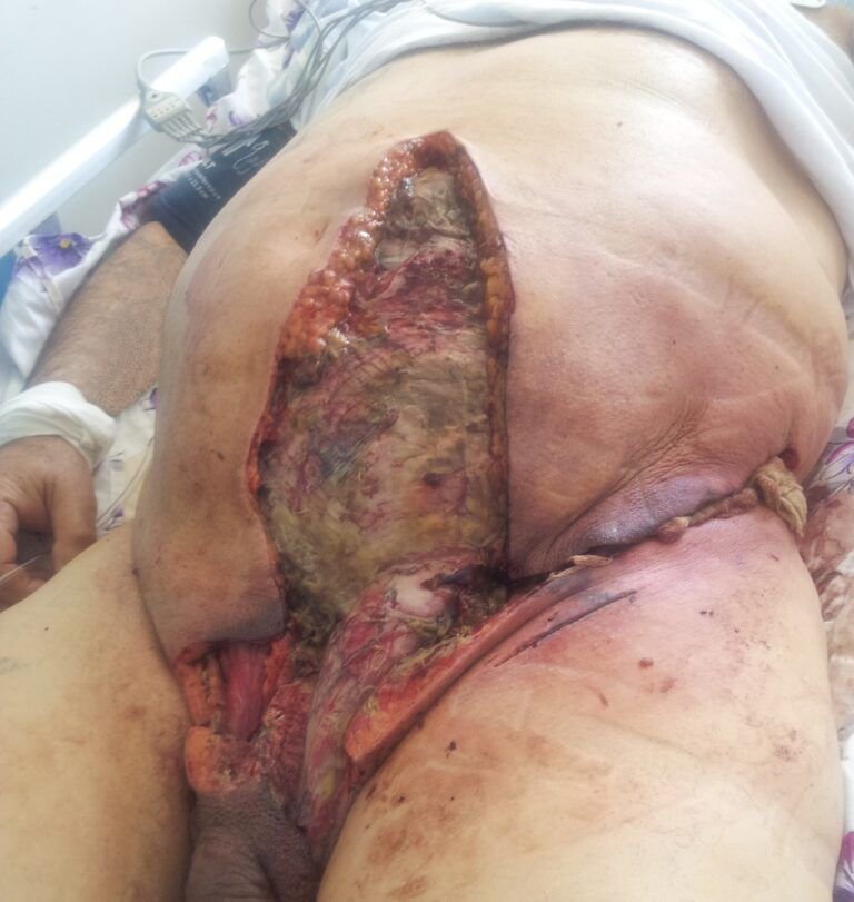 Gangrena de Fournier: síntomas, causas, tratamiento y señales de alarma
