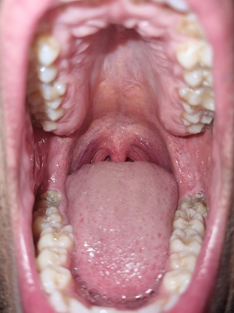 Hongos en la boca: síntomas, causas, tratamiento y cómo prevenir la candidiasis oral