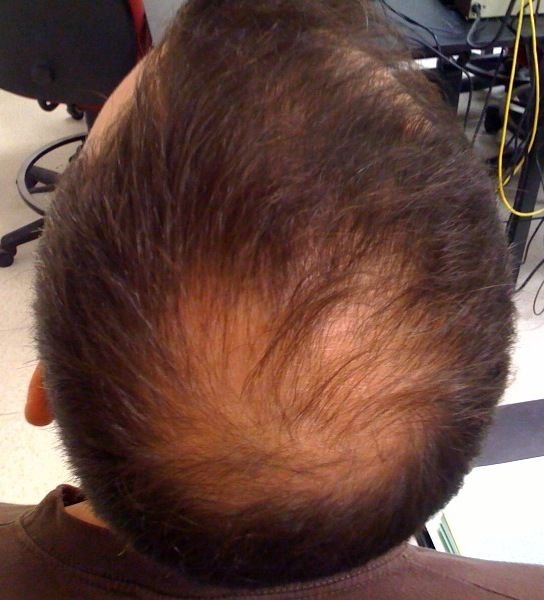Minoxidil tópico: para qué sirve, cómo se aplica, efectos secundarios y resultados