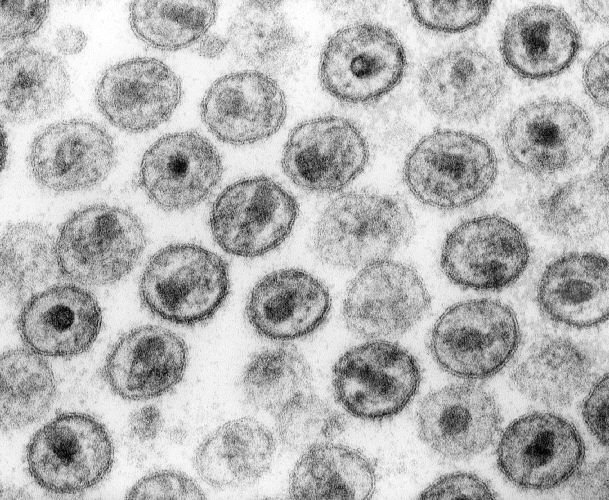 VIH y sida: qué es, síntomas, transmisión, tratamiento y prevención